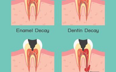 8 SIGNS OF TOOTH DECAY